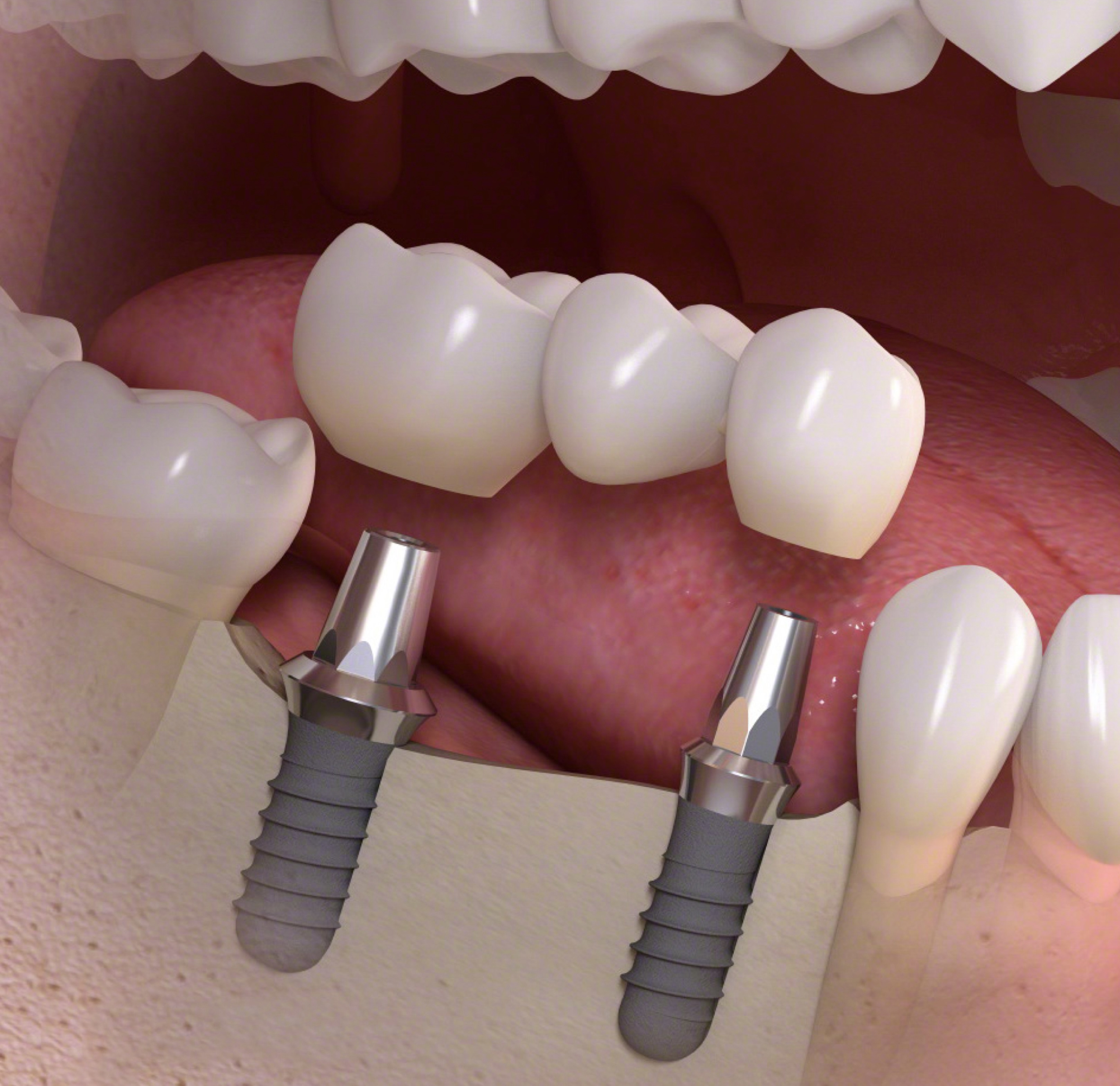 Установка мостовидных протезов зубов в Калуге