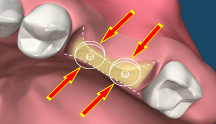 Костная пластика
