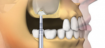 Синуслифтинг