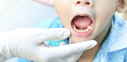 Пластика уздечки у детей