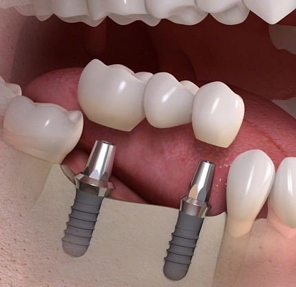 Коронки и мостовидные протезы