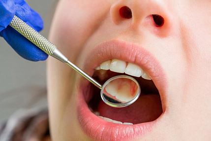 Лечение кариеса