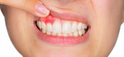 Лечение десен